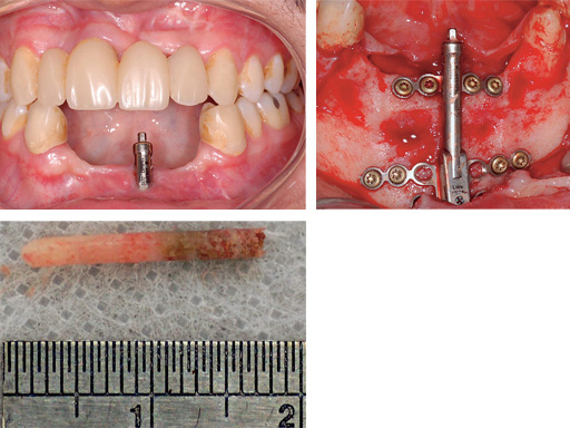 Alveolar-Distractor-case-03