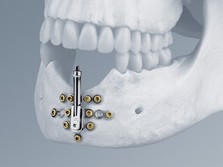 Alveolar Distractor
