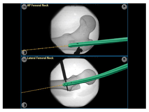 Axis_Reduction_and_Alignment_Module_1