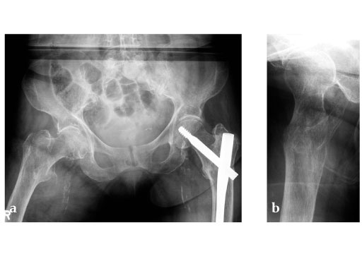 Dynamic_Hip_Screw_Blade_2