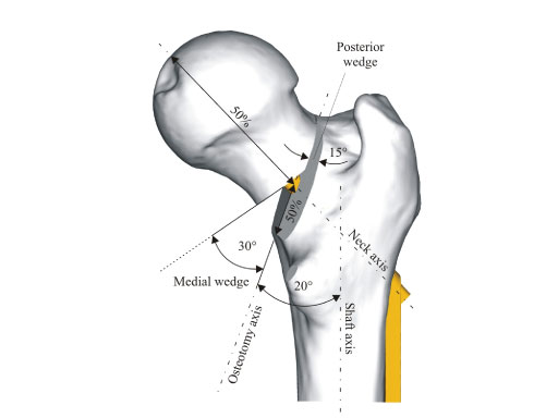 Dynamic_Hip_Screw_Blade_5