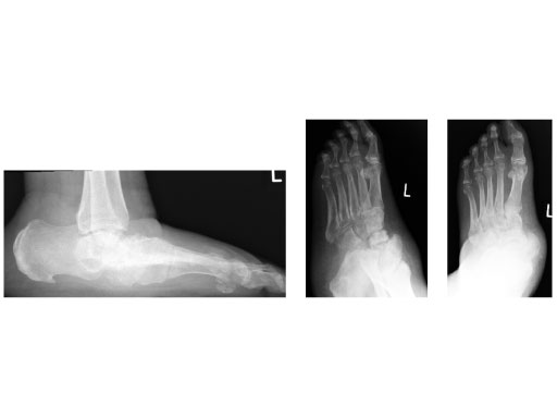 Expert_Hindfoot_Arthrodesis_Nail_2