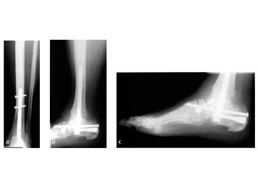 Analysis of bone transport for ankle arthrodesis as a limb salvage procedure  for the treatment of septic pilon fracture nonunion | Scientific Reports