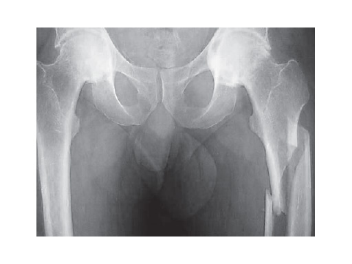 expert_lat_femoral_nail_4