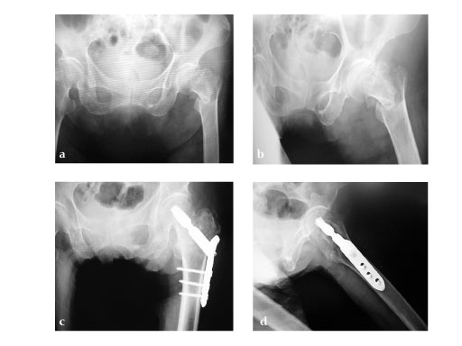 LCP_DHS_with_Collar_2
