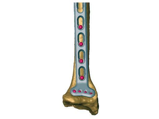 LCP_MetaDiaphyseal_Vol_DR_Plate_5