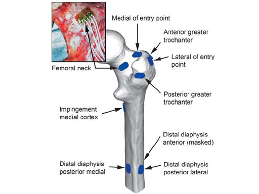 Image is a lateral femur X-ray with a cephalomedullary nail resulting... |  Download Scientific Diagram