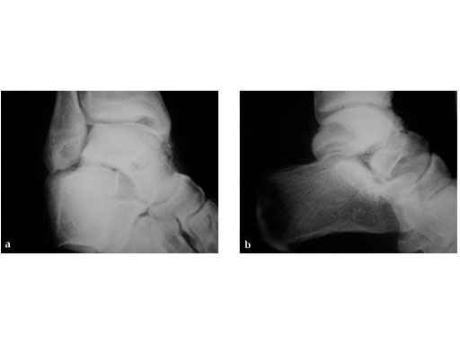 Locking_Talus_Plate_2-4_2