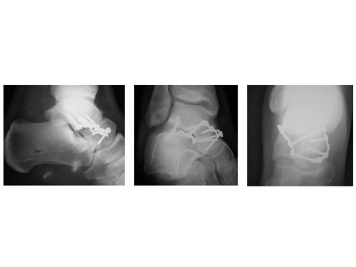 Locking_Talus_Plate_2-4_4