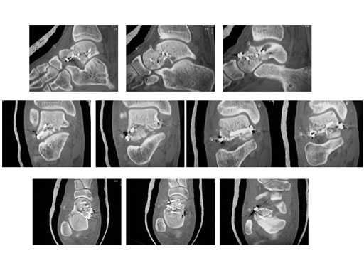 Locking_Talus_Plate_2-4_5
