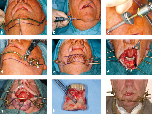 mandible_ext_fix2_4
