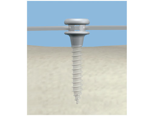 orthodontic_bone_anc_2