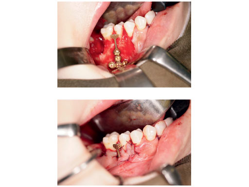 orthodontic_bone_anc_3