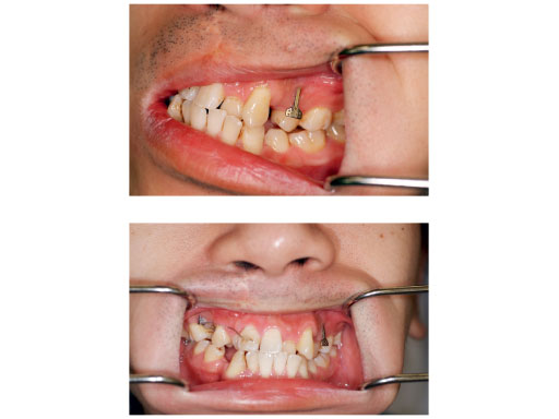 orthodontic_bone_anc_4