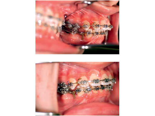 orthodontic_bone_anc_5