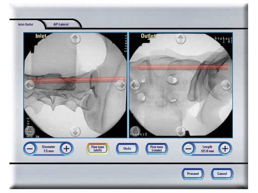 Posterior_Pelvic_Ring_Fixation_Module_1