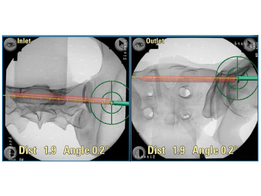 Posterior_Pelvic_Ring_Fixation_Module_2