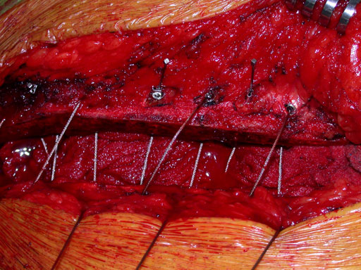 Sternal_Cable_C0950_7
