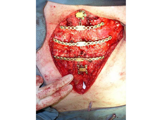 Sternal_Plating_System_MD951_10