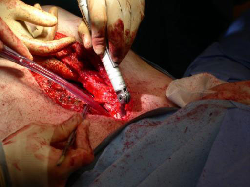 Sternal_Plating_System_MD951_4