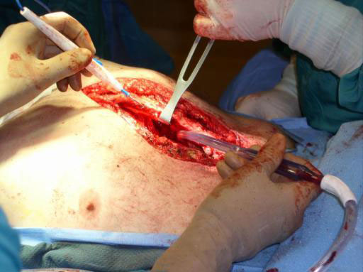 Sternal_Plating_System_MD951_5