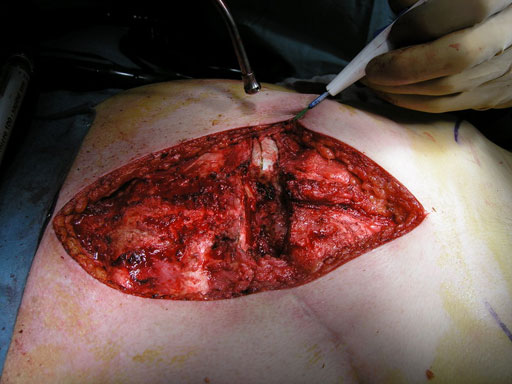 Sternal_Plating_System_MD951_6