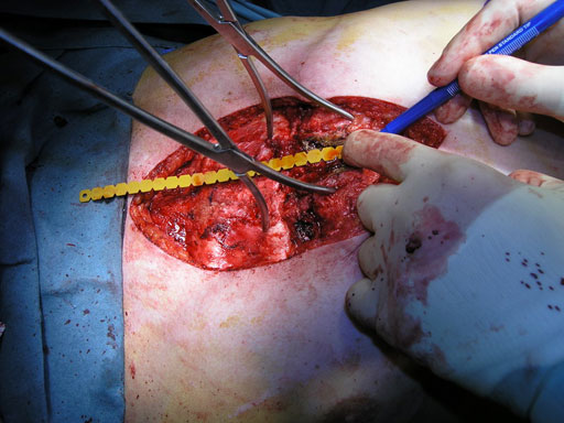 Sternal_Plating_System_MD951_7