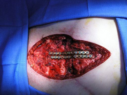 Sternal_Plating_System_MD951_8