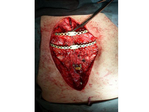 Sternal_Plating_System_MD951_9