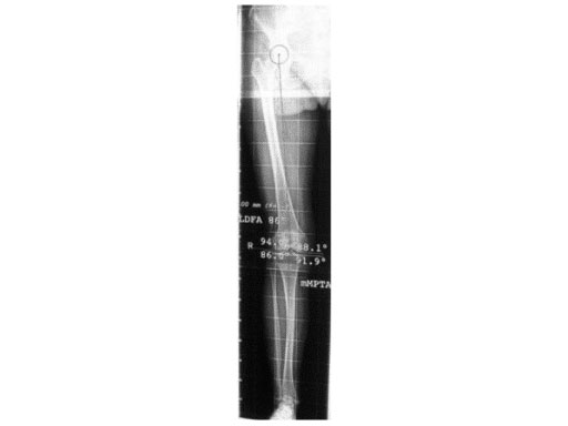 TomoFix_Medial_Distal_Femur_2