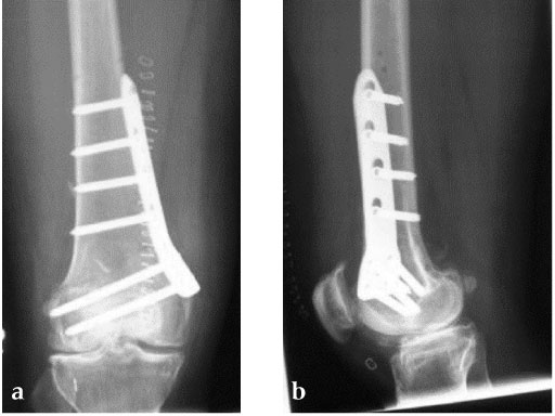 TomoFix_Medial_Distal_Femur_3