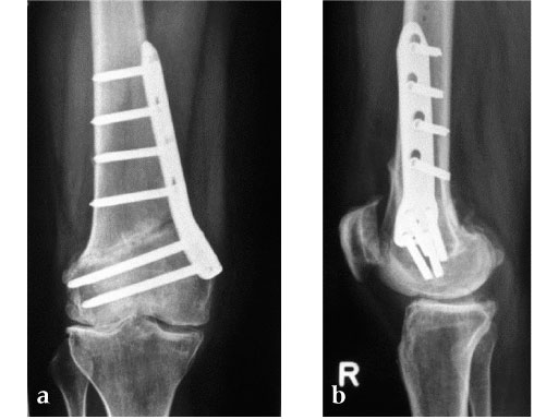 TomoFix_Medial_Distal_Femur_4