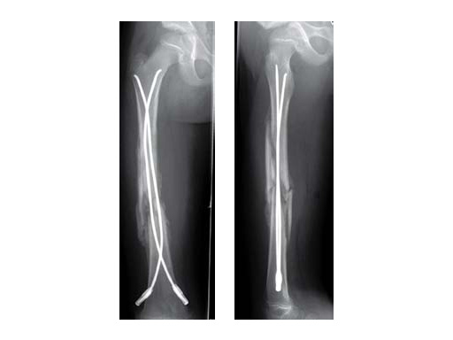 JBJS: Complications of Titanium and Stainless Steel Elastic Nail Fixation  of Pediatric Femoral Fractures