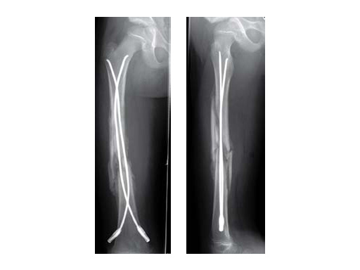 Evolution of Intramedullary Nails for Long Bone Fractures in the Upper Limb  | SpringerLink