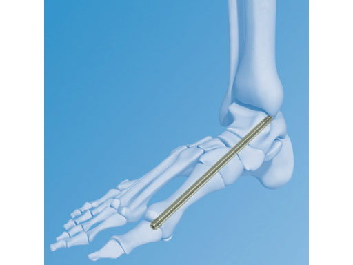 6-5mmMidfootFusionBolt_1