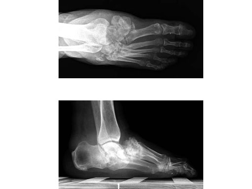 6-5mmMidfootFusionBolt_3