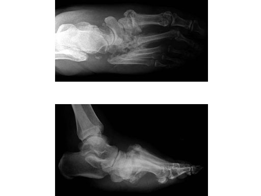 6-5mmMidfootFusionBolt_5