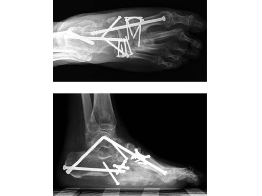 6-5mmMidfootFusionBolt_6