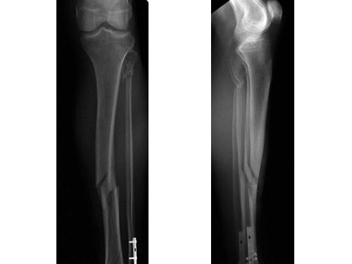 ExpertTitaniumCannulatedTibialNailwProximalBend_3