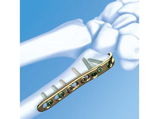 LCPDistalUlnaPlate2-0_1