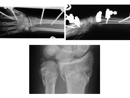 LCPDistalUlnaPlate2-0_3