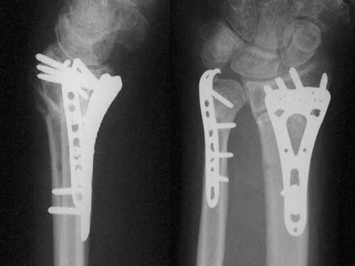 LCPDistalUlnaPlate2-0_4