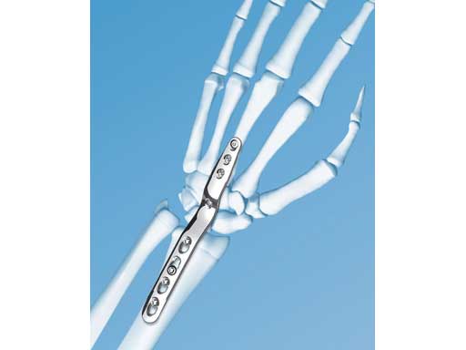 LCPWristFusionPlate_2