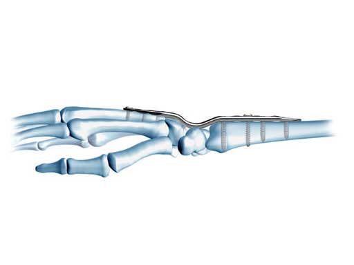 LCPWristFusionPlate_3