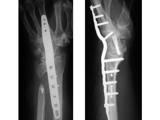 LCPWristFusionPlate_4