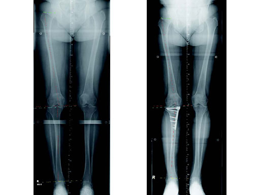 TomoFixMedialHighTibia_4