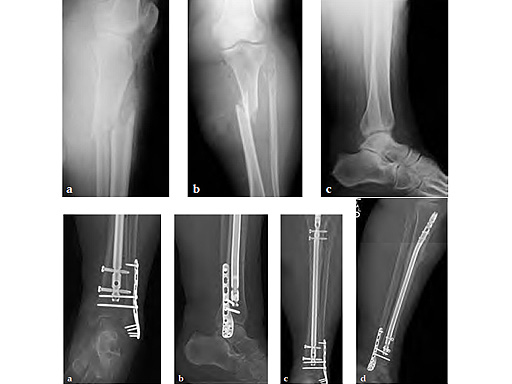 2-7_3-5mmLCPLateralDistalFibula_5