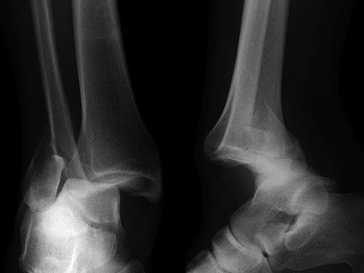 2-7_3-5mmLCPPosterolateralDistalFibula_4