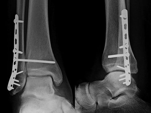 2-7_3-5mmLCPPosterolateralDistalFibula_5