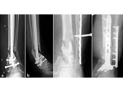 3-5LCPDistalTibiaT-Plate_3